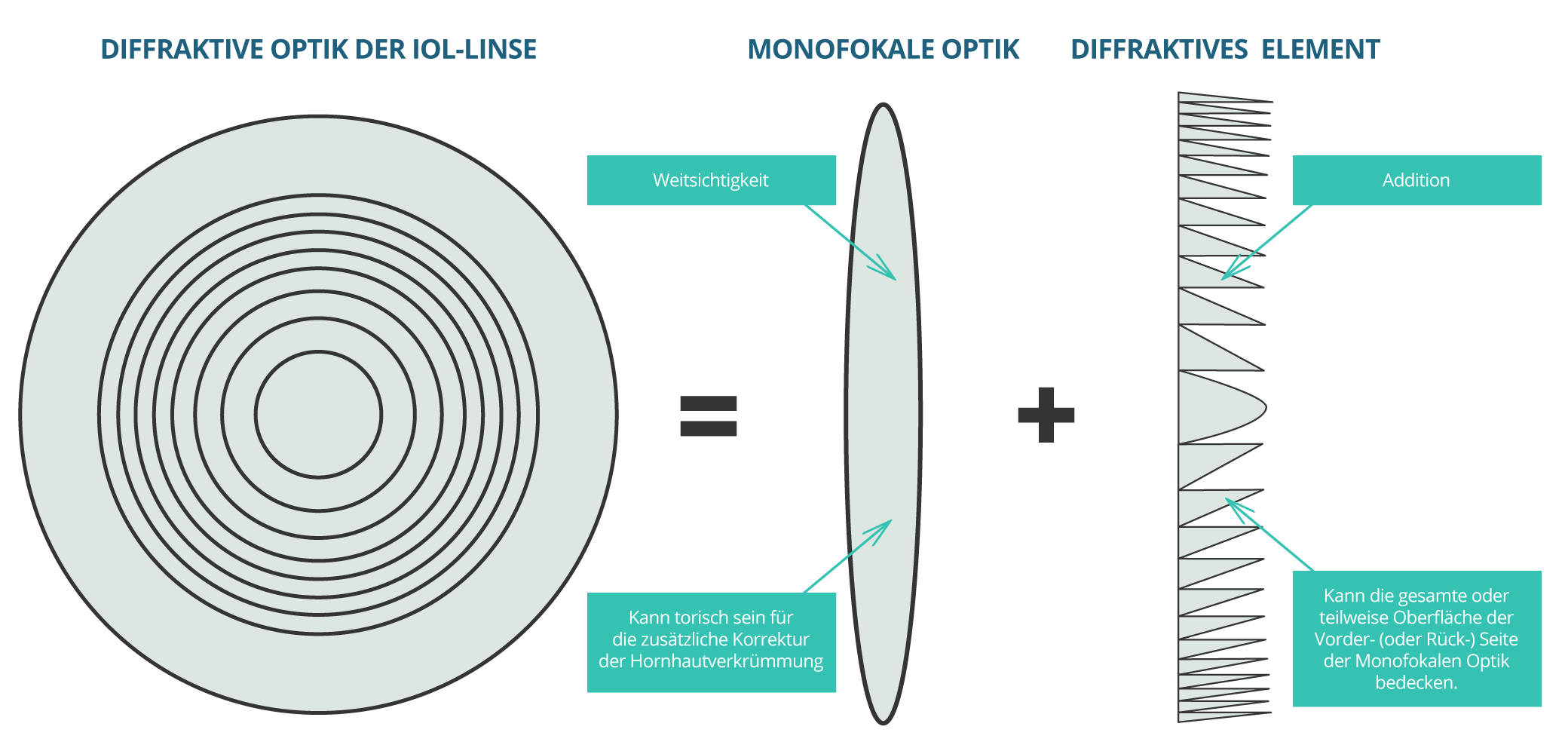 Arten an Intraokularlinsen